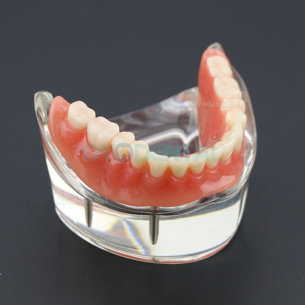 Demo-onderzoek tandheelkundige onderste tanden Model 6002 02 Overdenture Inferior 4 implantaten